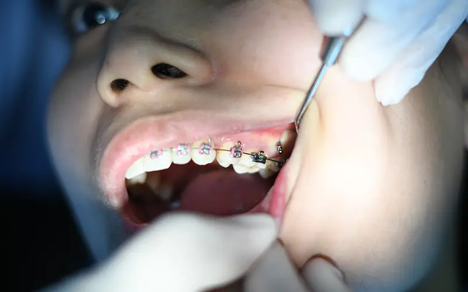 Do Braces Hurt? What To Expect During Each Stage Of Treatment